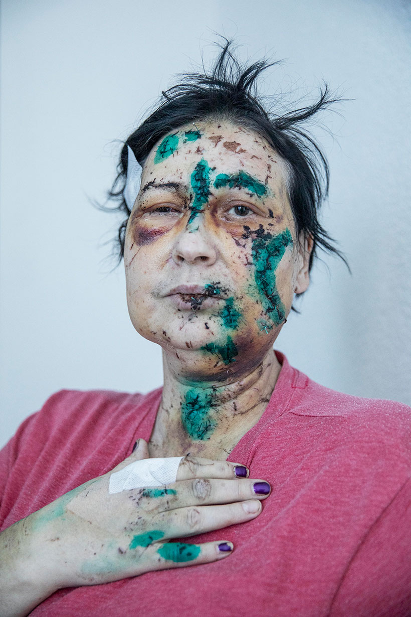 ‘Yelena Burainchenko, injured when her apartment building was shelled by Russian forces. Doctors and nurses, who are on their knees, use green disinfectant to treat the open wounds’ by Jack Hill / The Times