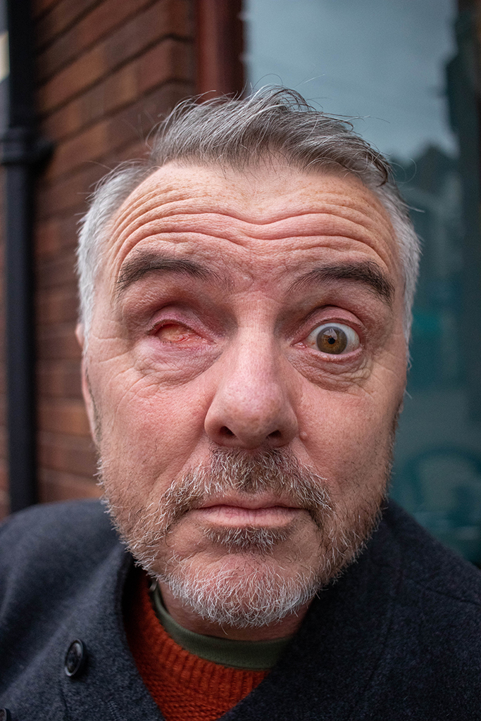 close-up portrait of a man with one eye, both wide open
