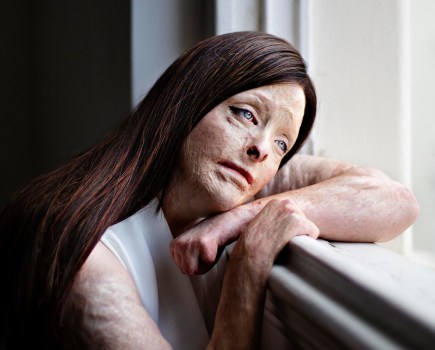 portrait of a burn survivor looking out of a window